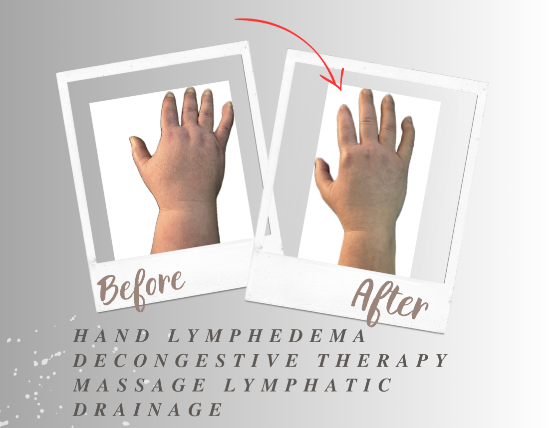 LYMPHEDEMA decongestive THERAPY Lymphatic draining massage